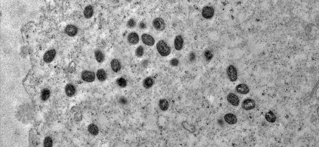 Brasil já registrou 81 casos do vírus mpox em 2026