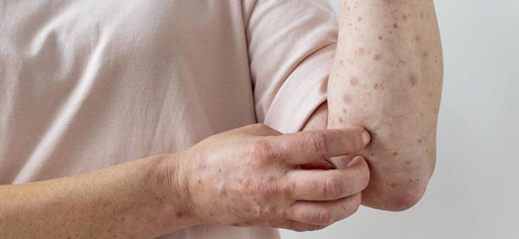 Brasil registra 140 casos confirmados de Mpox em 2026